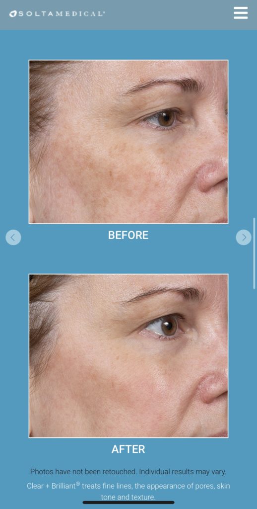 Clear Brilliant Preventative Skin Treatment