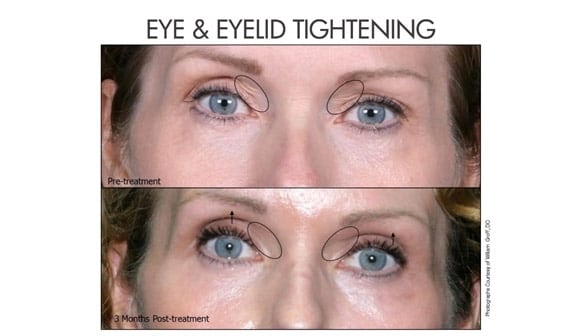 before after eyelid thightening 1