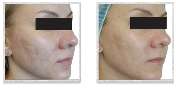 Fractional Radiofrequency Skin Resurfacing Viva Martha E Stewart Md Llc