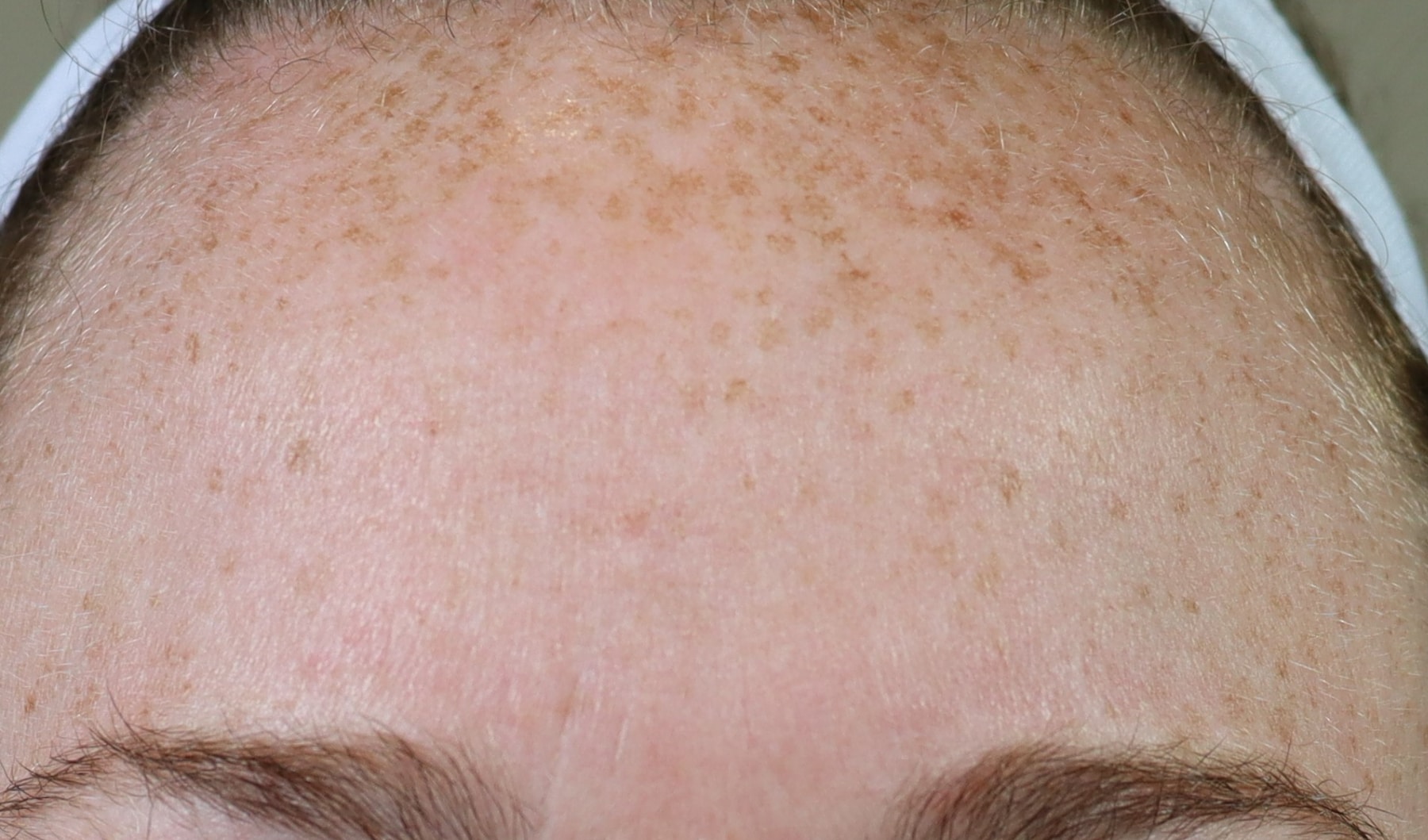 Beautiful Martha Stewart Microneedling Photo Concept Beautiful Martha Stewart Microneedling Photo Concept