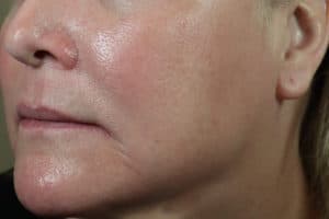 Microneedling plus Skincare