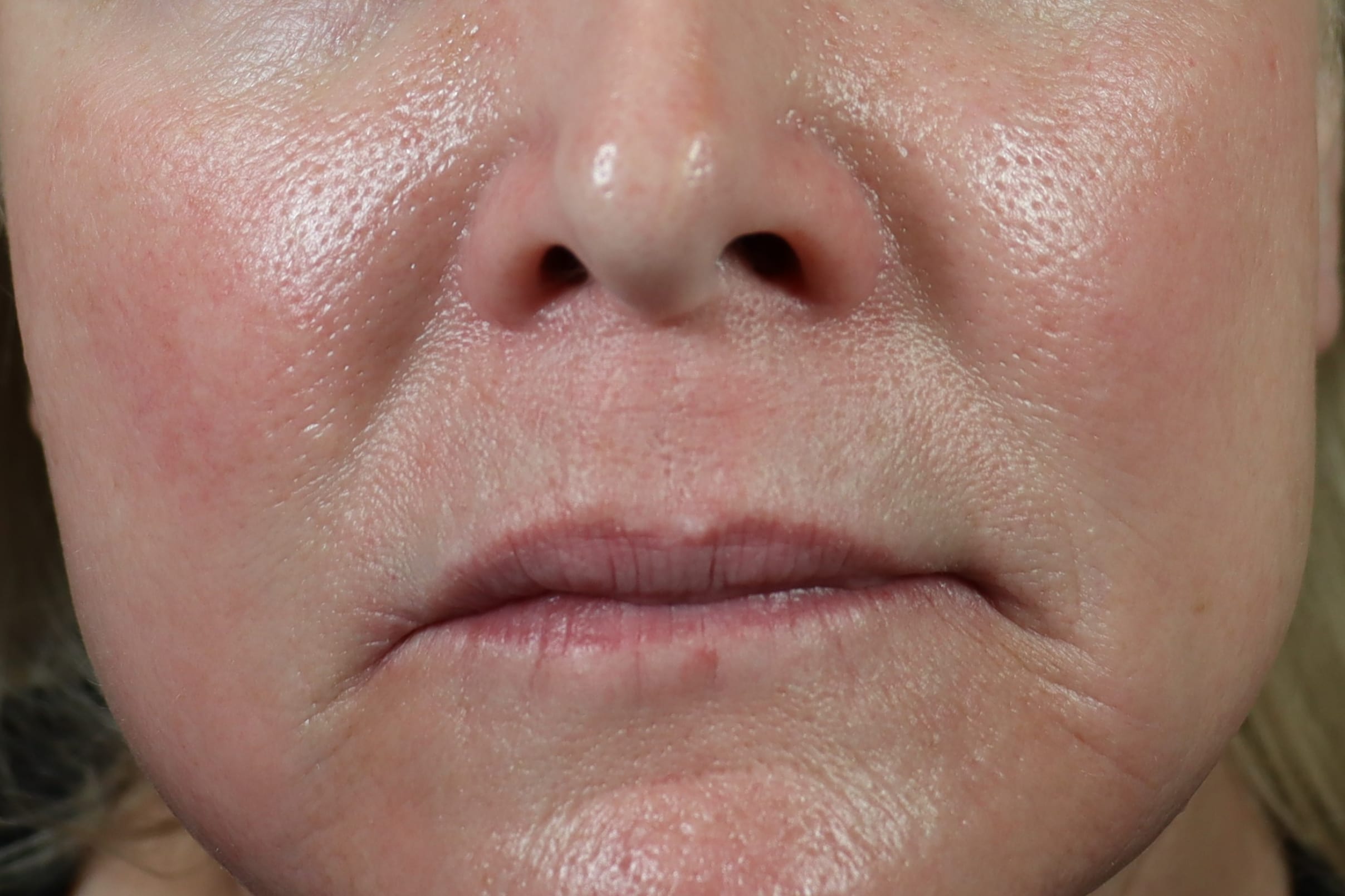 Captivating Martha Stewart Microneedling Wallpaper Concept Captivating Martha Stewart Microneedling Wallpaper Concept