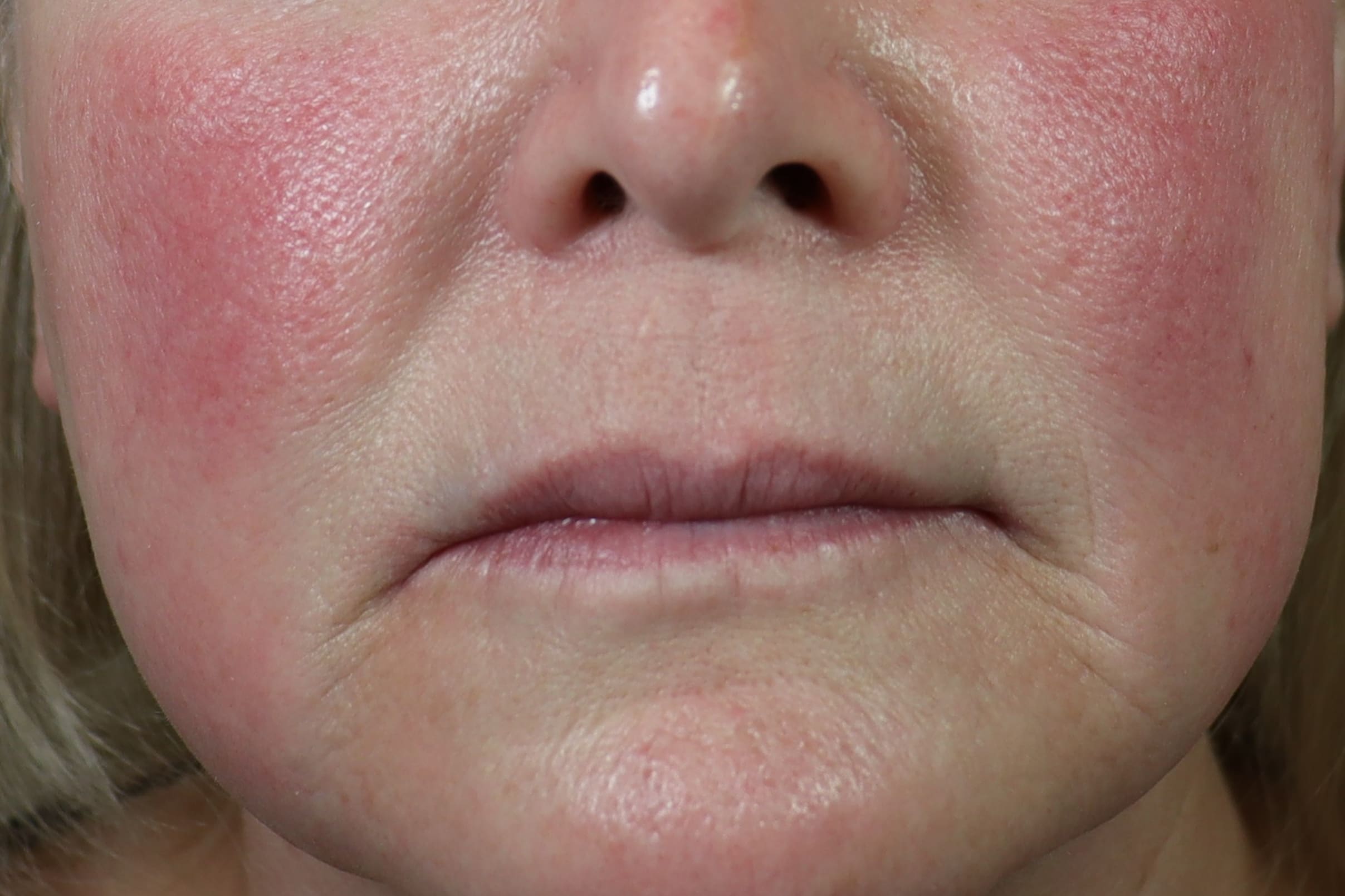 High-Quality Martha Stewart Microneedling Landscape for Desktop High-Quality Martha Stewart Microneedling Landscape for Desktop