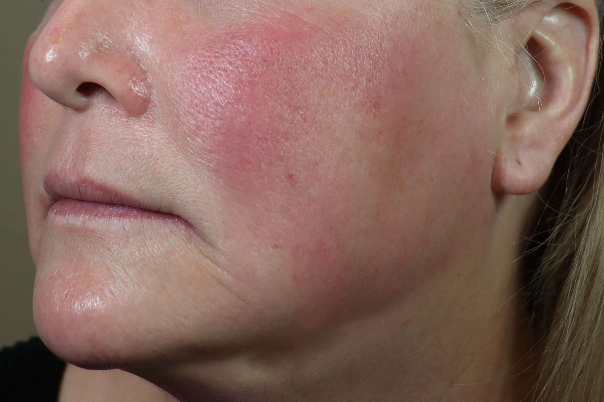 Amazing Martha Stewart Microneedling Wallpaper in HD Amazing Martha Stewart Microneedling Wallpaper in HD