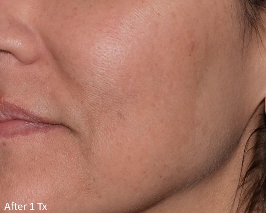 After Image: LaserMD Ultra - left-front-oblique