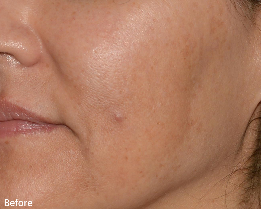 Before Image: LaserMD Ultra - left-front-oblique