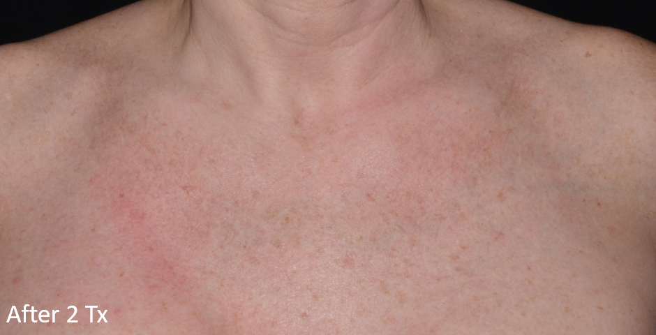 After Image: LaserMD Ultra - front