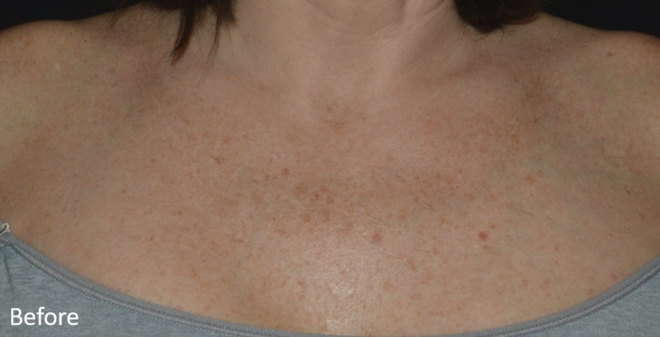 Before Image: LaserMD Ultra - front