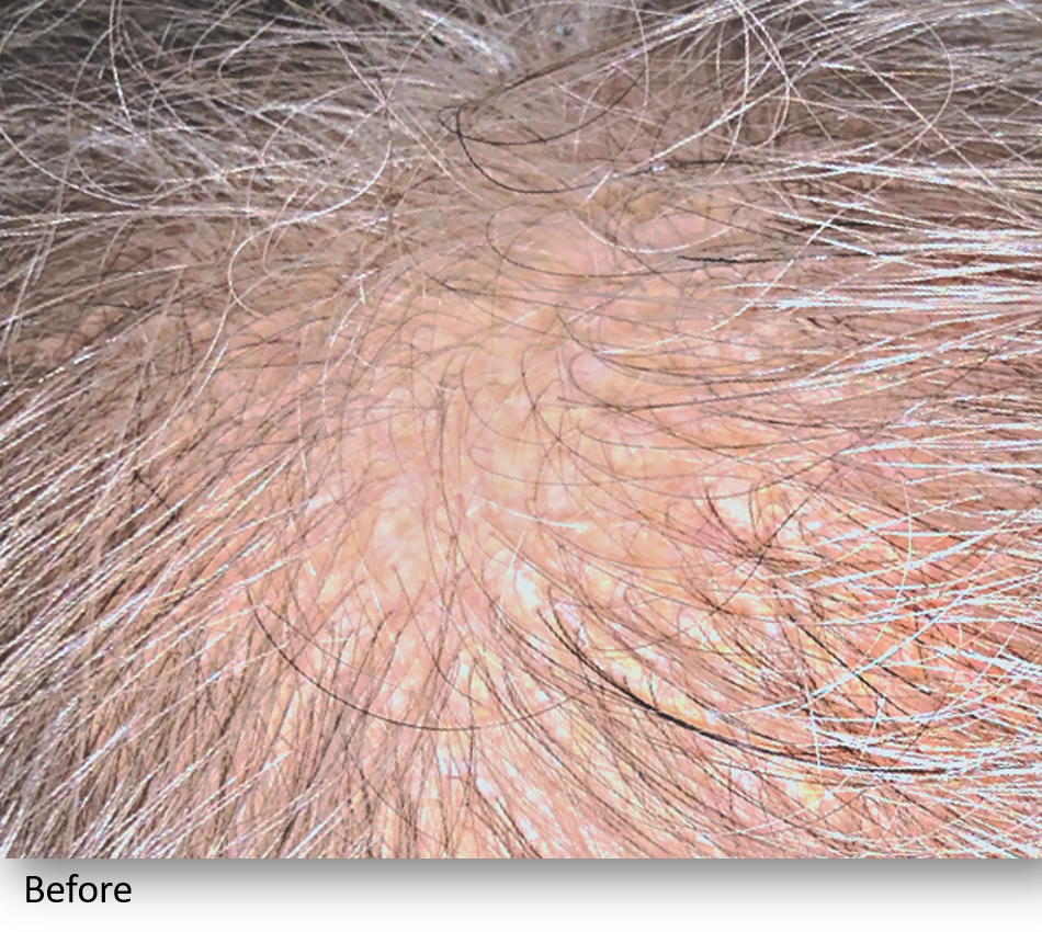 Before Image: Keralase - front