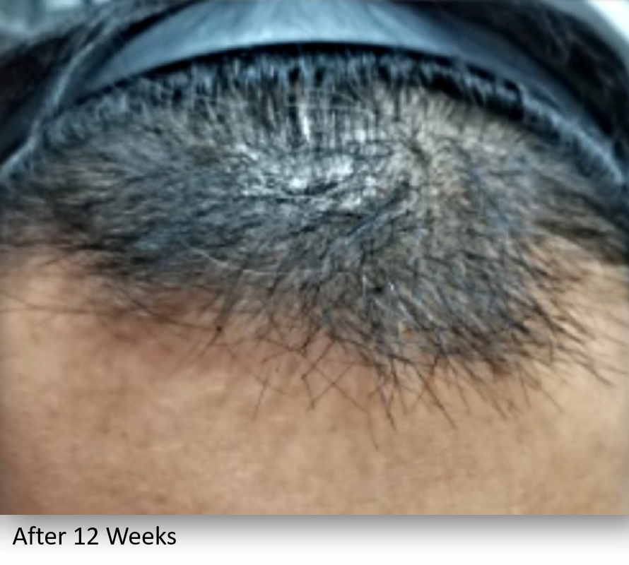 After Image: Keralase - front