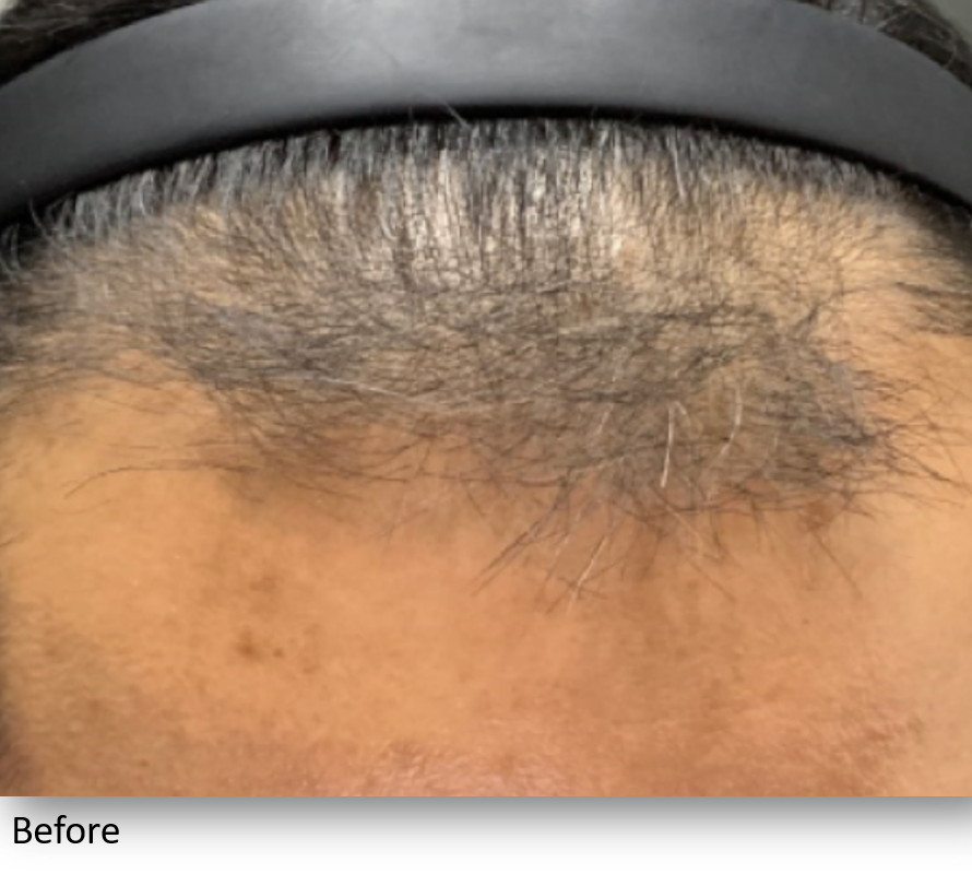 Before Image: Keralase - front