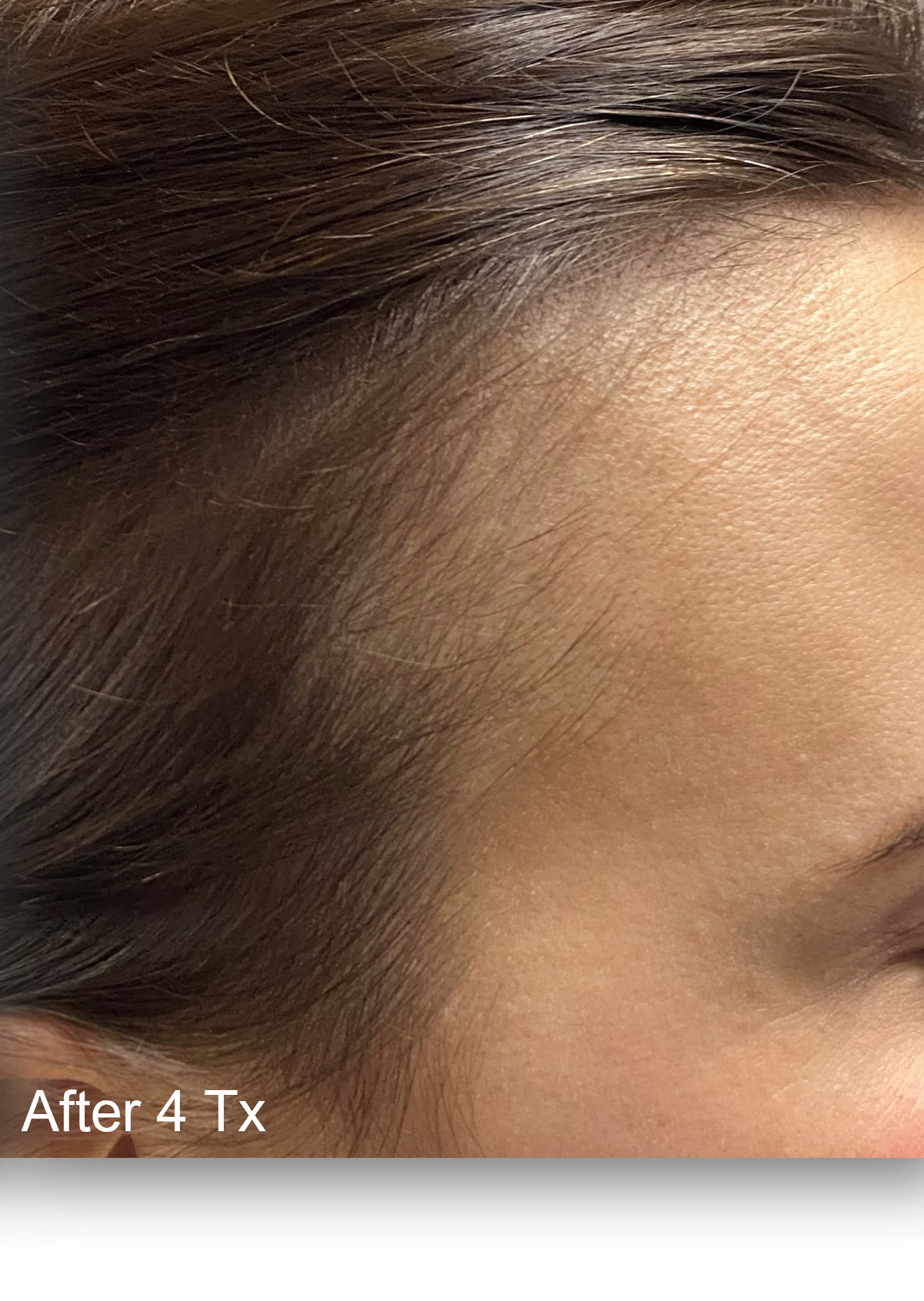 After Image: Keralase - right-side