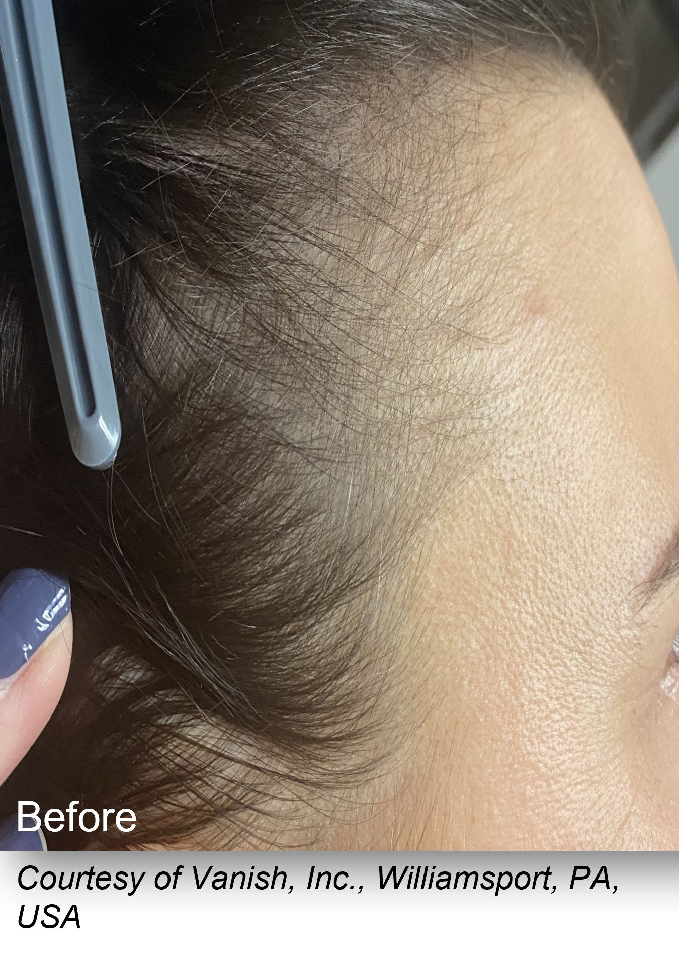 Before Image: Keralase - right-side