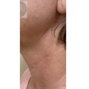 Airgent Neck lines after 3 treatments