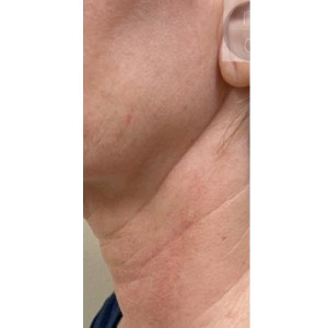 Airgent Neck lines after 3 treatments